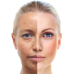 What is Liquid Facelift ?