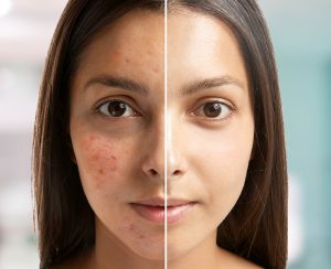 The Youth Elixir for Skin and Hair: A Complete Guide to Mesotherapy